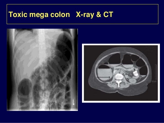 Antibiotic Associated Diarrhea Clostridium Difficile Infection