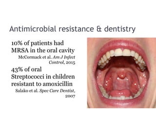 Antimicrobial resistance & dentistry
10% of patients had
MRSA in the oral cavity
McCormack et al. Am J Infect
Control, 2015
43% of oral
Streptococci in children
resistant to amoxicillin
Salako et al. Spec Care Dentist,
2007
 