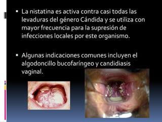  La nistatina es activa contra casi todas las
levaduras del género Cándida y se utiliza con
mayor frecuencia para la supresión de
infecciones locales por este organismo.
 Algunas indicaciones comunes incluyen el
algodoncillo bucofaríngeo y candidiasis
vaginal.
 