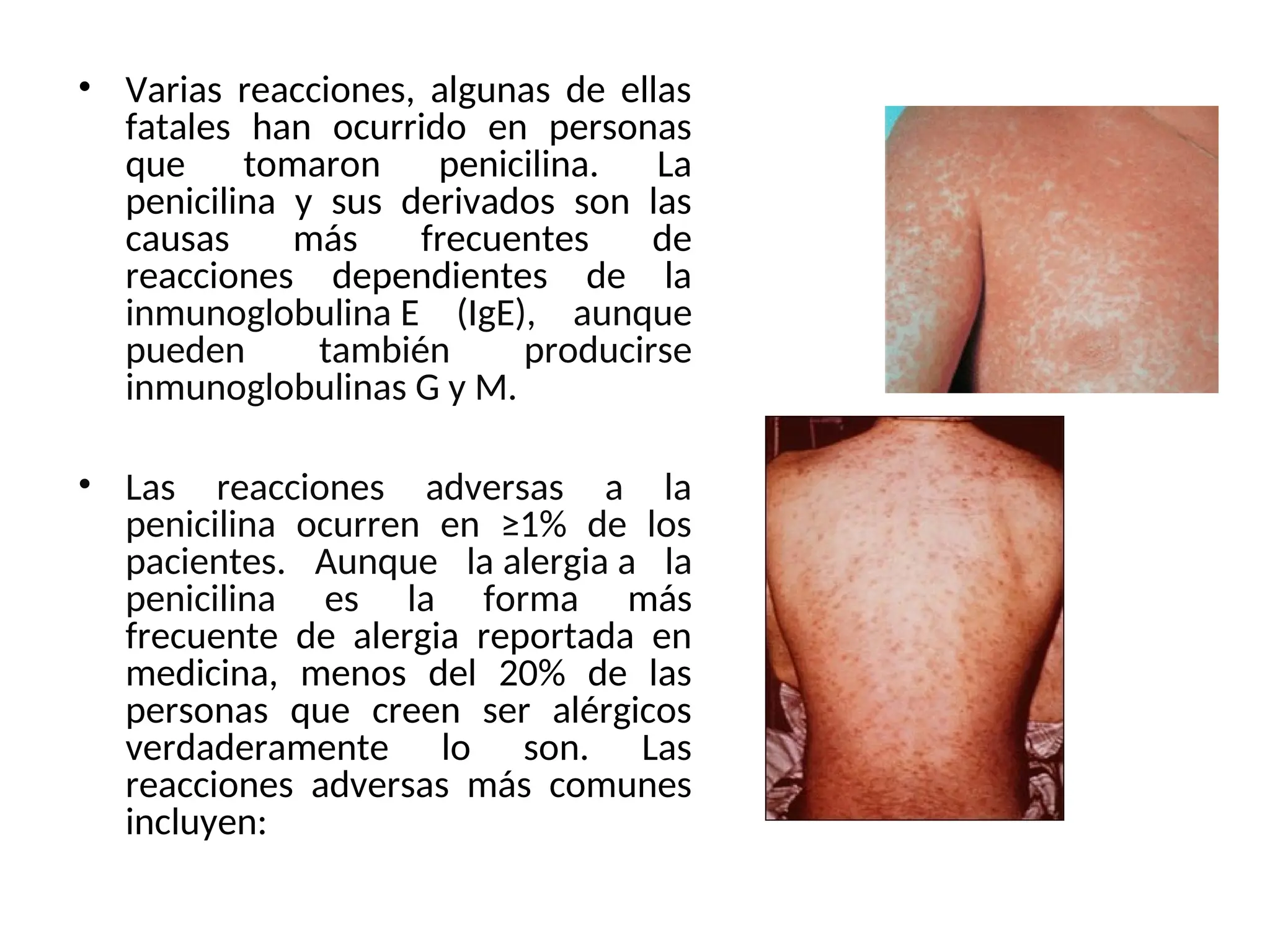 • Varias reacciones, algunas de ellas
fatales han ocurrido en personas
que tomaron penicilina. La
penicilina y sus derivados son las
causas más frecuentes de
reacciones dependientes de la
inmunoglobulina E (IgE), aunque
pueden también producirse
inmunoglobulinas G y M.
• Las reacciones adversas a la
penicilina ocurren en ≥1% de los
pacientes. Aunque la alergia a la
penicilina es la forma más
frecuente de alergia reportada en
medicina, menos del 20% de las
personas que creen ser alérgicos
verdaderamente lo son. Las
reacciones adversas más comunes
incluyen:
 