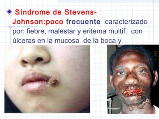 Síndrome de Stevens-
Johnson:poco frecuente caracterizado
por: fiebre, malestar y eritema multif. con
úlceras en la mucosa de la boca y
genitales.
 