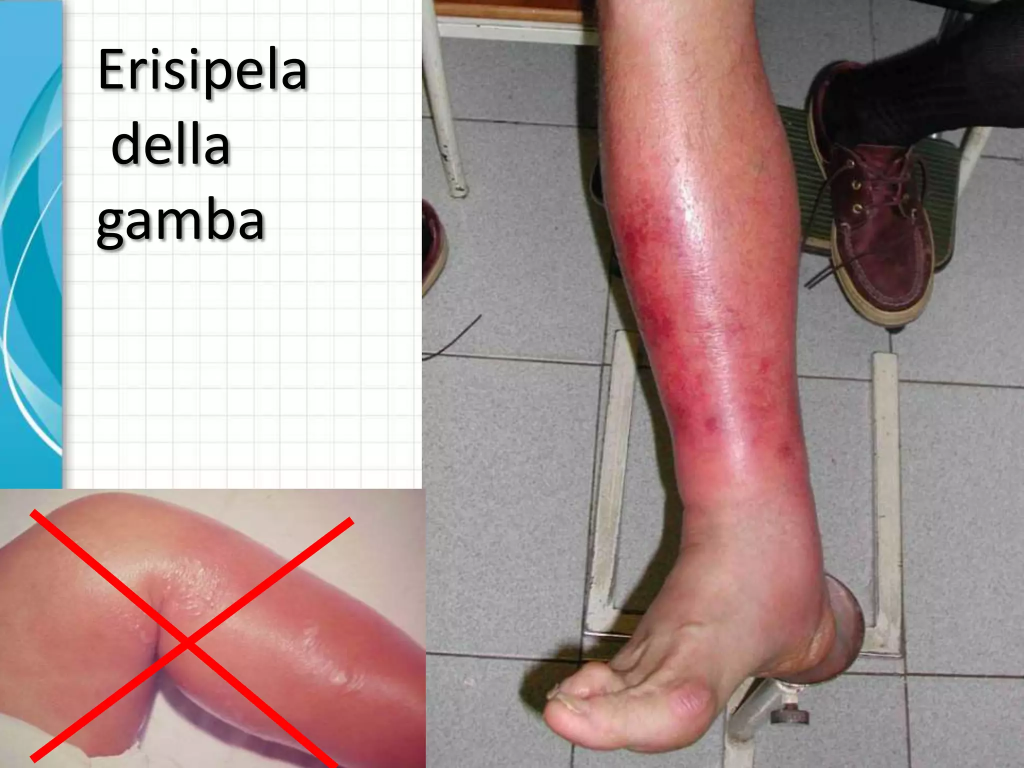 Antibioticoterapia nelle complicanze infettive del linfedema | PPTX, image size:2048x1536