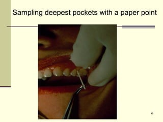 Paper Point Sampling Common Antibiotics : Used in periodontal therapy, easy approach for ...