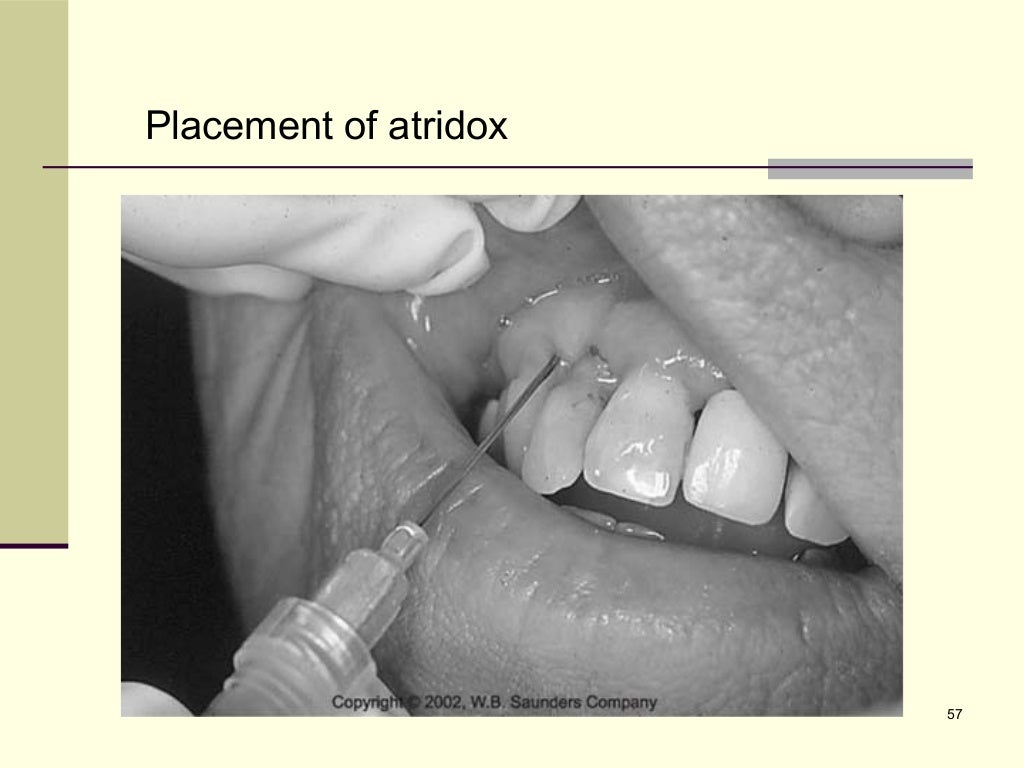 Common Antibiotics Used in periodontal therapy, easy approach for t…