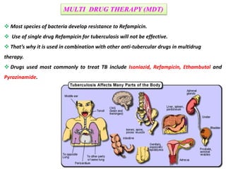 Most species of bacteria develop resistance to Refampicin.
 Use of single drug Refampicin for tuberculosis will not be effective.
 That’s why it is used in combination with other anti-tubercular drugs in multidrug
therapy.
 Drugs used most commonly to treat TB include Isoniazid, Refampicin, Ethambutol and
Pyrazinamide.
MULTI DRUG THERAPY (MDT)
 