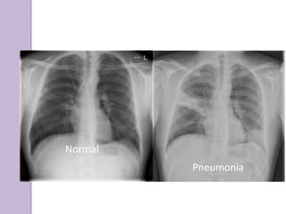 Normal
Pneumonia
 