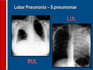 30
Lobar Pneumonia – S.pneumoniae
 