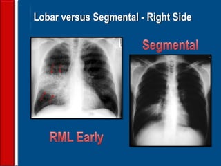 32
Lobar versus Segmental - Right Side
 
