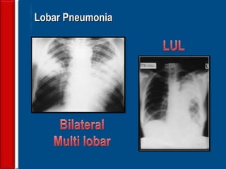 33
Lobar Pneumonia
 