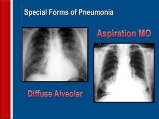 36
Special Forms of Pneumonia
 