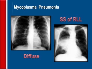 40
Mycoplasma Pneumonia
 