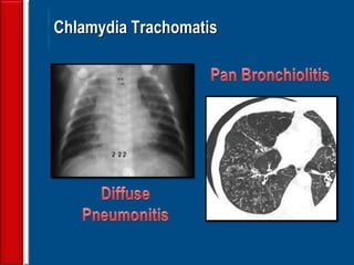 42
Chlamydia Trachomatis
 