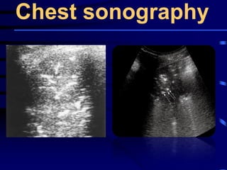 Chest sonography
 