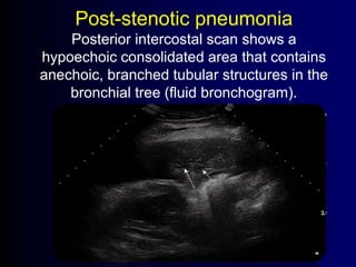 Post-stenotic pneumonia
Posterior intercostal scan shows a
hypoechoic consolidated area that contains
anechoic, branched tubular structures in the
bronchial tree (fluid bronchogram).
 