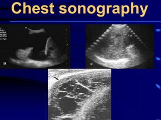 Chest sonography
 