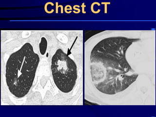Chest CT
 