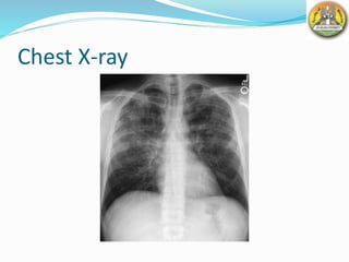 Chest X-ray
 