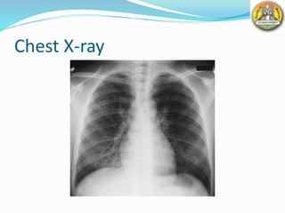 Chest X-ray
 