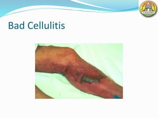 Bad Cellulitis
 