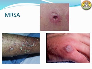MRSA
 