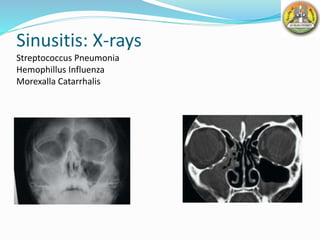 Sinusitis: X-rays
Streptococcus Pneumonia
Hemophillus Influenza
Morexalla Catarrhalis
 