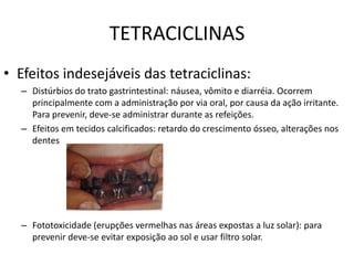 TETRACICLINAS
• Efeitos indesejáveis das tetraciclinas:
  – Distúrbios do trato gastrintestinal: náusea, vômito e diarréia. Ocorrem
    principalmente com a administração por via oral, por causa da ação irritante.
    Para prevenir, deve-se administrar durante as refeições.
  – Efeitos em tecidos calcificados: retardo do crescimento ósseo, alterações nos
    dentes




  – Fototoxicidade (erupções vermelhas nas áreas expostas a luz solar): para
    prevenir deve-se evitar exposição ao sol e usar filtro solar.
 