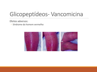 Glicopeptídeos- Vancomicina
Efeitos adversos:
◦ Síndrome do homem vermelho
 