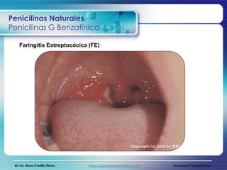 Penicilinas Naturales
Penicilinas G Benzatínica

    Faringitis Estreptocócica (FE)




 EU-Lic. Rene Castillo Flores   www.CapacitacionesOnline.com   Innovares Capacitación
 