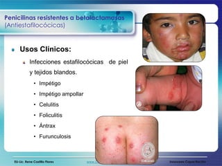 Penicilinas resistentes a betalactamasas
(Antiestafilocócicas)


      Usos Clínicos:
             Infecciones estafilocócicas de piel
             y tejidos blandos.
                • Impétigo
                • Impétigo ampollar
                • Celulitis
                • Foliculitis
                • Ántrax
                • Furunculosis



   EU-Lic. Rene Castillo Flores       www.CapacitacionesOnline.com   Innovares Capacitación
 