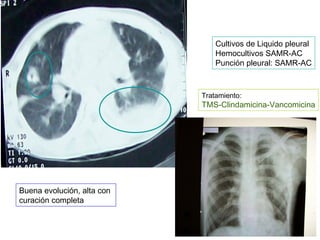 Cultivos de Liquido pleural
                                Hemocultivos SAMR-AC
                                Punción pleural: SAMR-AC



                            Tratamiento:
                            TMS-Clindamicina-Vancomicina




Buena evolución, alta con
curación completa
 