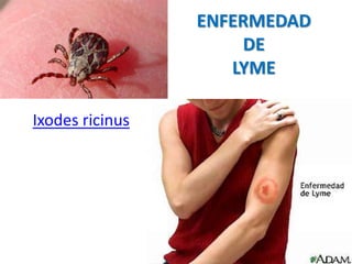 ENFERMEDAD
DE
LYME
Ixodes ricinus
 