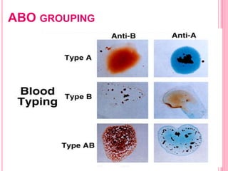 ABO GROUPING
 