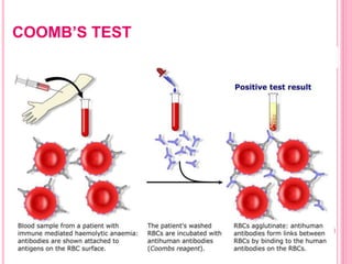 COOMB’S TEST
 
