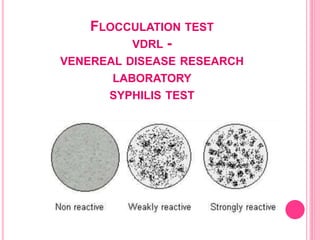 FLOCCULATION TEST
VDRL -
VENEREAL DISEASE RESEARCH
LABORATORY
SYPHILIS TEST
 