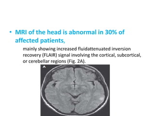 • MRI of the head is abnormal in 30% of
affected patients,
mainly showing increased fluidattenuated inversion
recovery (FLAIR) signal involving the cortical, subcortical,
or cerebellar regions (Fig. 2A).
 
