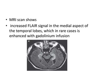 • MRI scan shows
• increased FLAIR signal in the medial aspect of
the temporal lobes, which in rare cases is
enhanced with gadolinium infusion
 