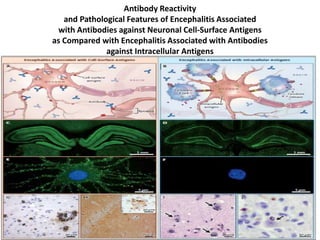 Antibody Reactivity
and Pathological Features of Encephalitis Associated
with Antibodies against Neuronal Cell-Surface Antigens
as Compared with Encephalitis Associated with Antibodies
against Intracellular Antigens
 