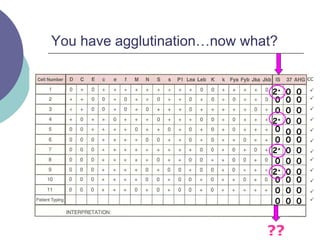 You have agglutination…now what?
2+
0
0
2+
0
0
2+
0
0
2+
0
0
0
0
0
0
0
0
0
0
0
0
0
0
0
0
0
0
0
0
0
0
0
0 0 0












??
CC
 