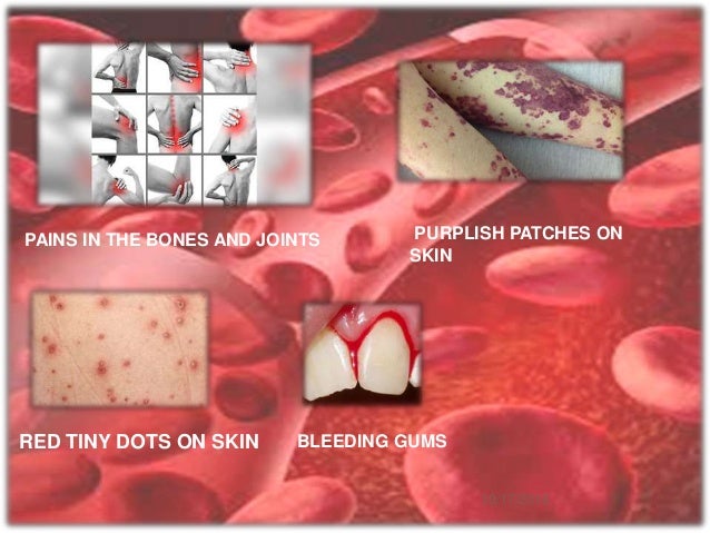 NEOPLASTIC DISEASE