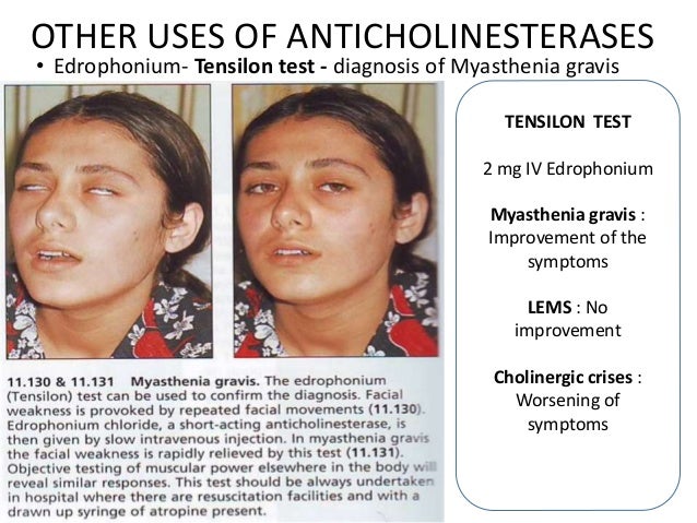 Myasthenia gravis neurological exam