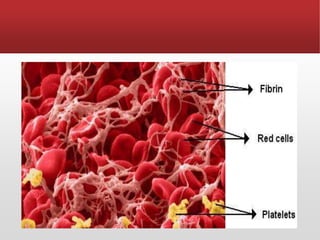 ▪The fibrinolytic system dissolves
intravascular clots as a result of
the action of plasmin, an
enzyme that digests fibrin...