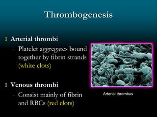 Thrombogenesis
 Platelet aggregates bound
together by fibrin strands
(white clots)
 Consist mainly of fibrin
and RBCs (red clots)
Arterial thrombus
 