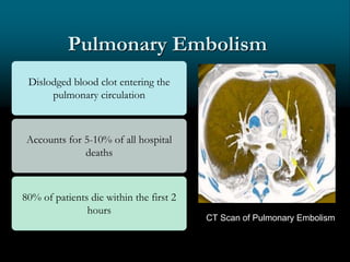 Pulmonary Embolism
Dislodged blood clot entering the
pulmonary circulation
Accounts for 5-10% of all hospital
deaths
80% of patients die within the first 2
hours
CT Scan of Pulmonary Embolism
 