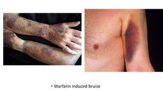 • Warfarin induced bruise
 
