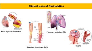 Clinical uses of fibrinolytics
Acute myocardial infarction
Deep vein thrombosis (DVT)
Pulmonary embolism (PE)
Stroke
 