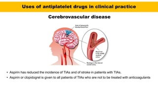Uses of antiplatelet drugs in clinical practice
Cerebrovascular disease
• Aspirin has reduced the incidence of TIAs and of stroke in patients with TIAs.
• Aspirin or clopidogrel is given to all patients of TIAs who are not to be treated with anticoagulants
 
