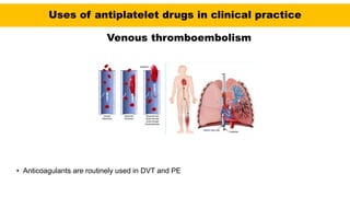 Uses of antiplatelet drugs in clinical practice
Venous thromboembolism
• Anticoagulants are routinely used in DVT and PE
 