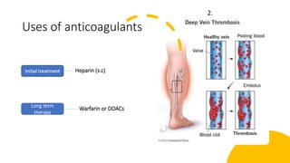 Uses of anticoagulants
Heparin (s.c)
Warfarin or DOACs
Initial treatment
Long term
therapy
2.
 
