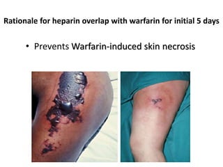 Rationale for heparin overlap with warfarin for initial 5 days
• Prevents Warfarin-induced skin necrosis
 