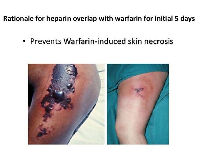warfarin overdose antidote warfarin overdose antidote